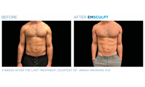 Get A Six-Packed Abs Before & After